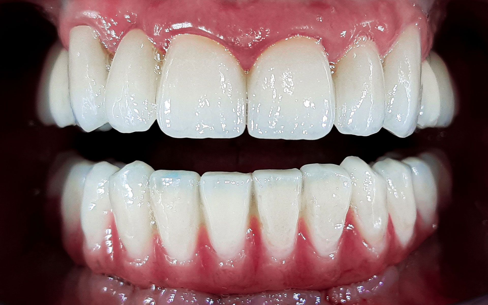 Primo piano di una bocca sorridente con denti bianchi e gengive rosse.