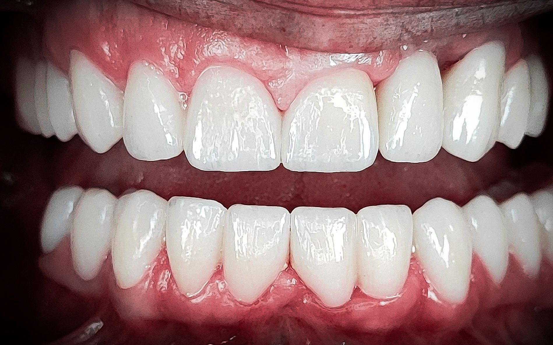 Primo piano di una bocca sorridente che mostra denti superiori e inferiori bianchi su gengive rosa