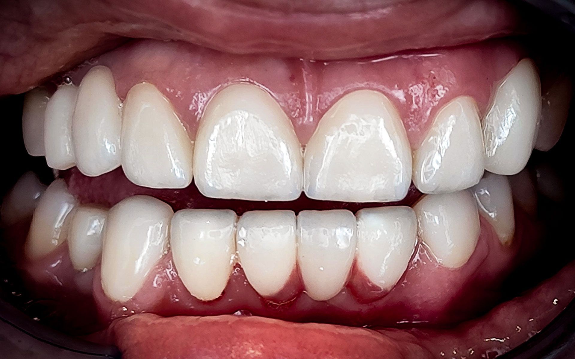 Primo piano di una bocca sorridente che mostra denti superiori e inferiori bianchi con gengive rosa