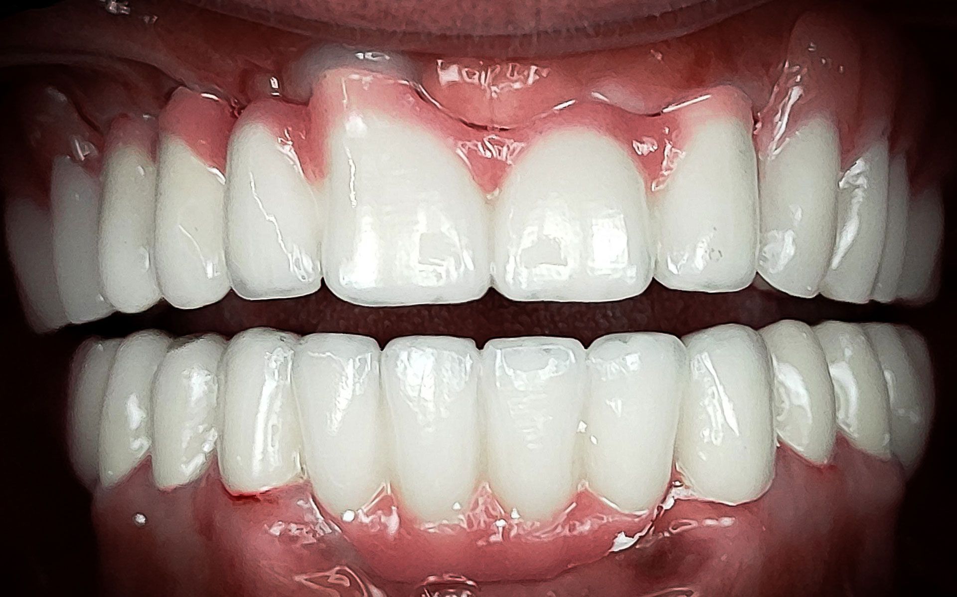 Primo piano di una bocca sorridente che mostra denti bianchissimi e gengive rosa.