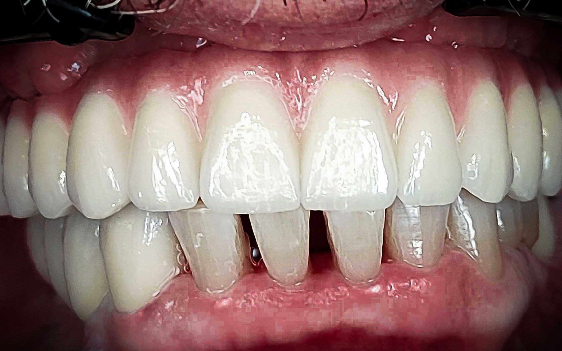 Primo piano dei denti frontali superiori e inferiori, con un evidente spazio tra i due incisivi centrali.