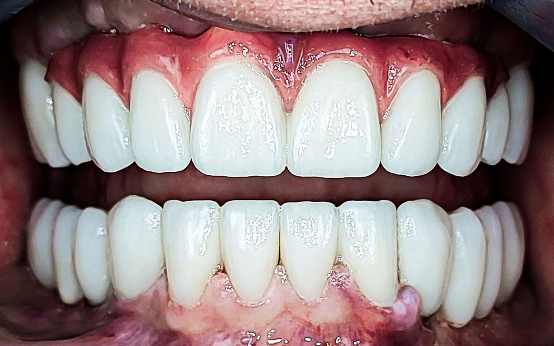 Primo piano di una bocca con denti bianchissimi e gengive rosa, con arcata superiore e inferiore ben visibili.