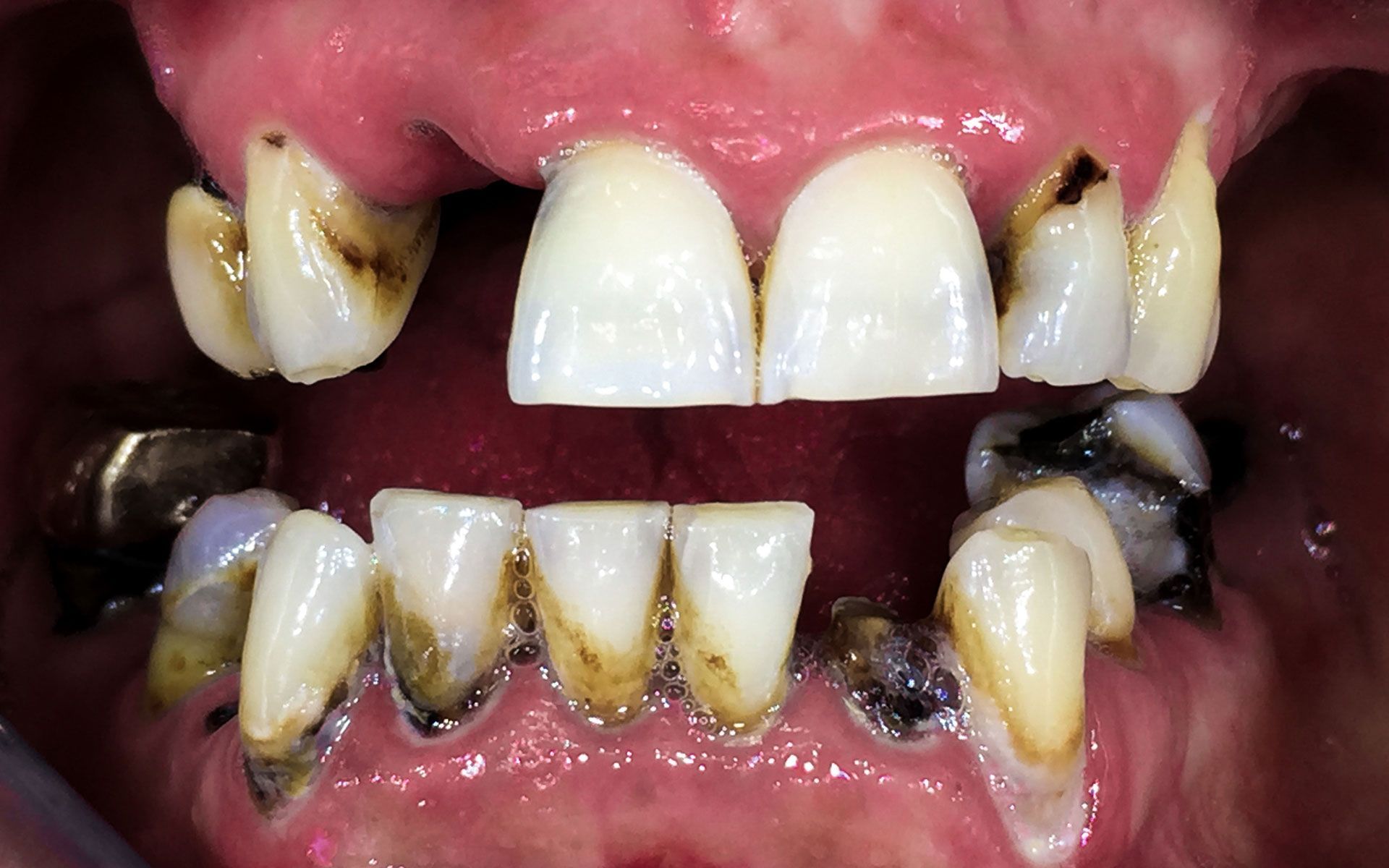Primo piano di denti gravemente cariati con placca scura e smalto mancante, in bocca aperta.