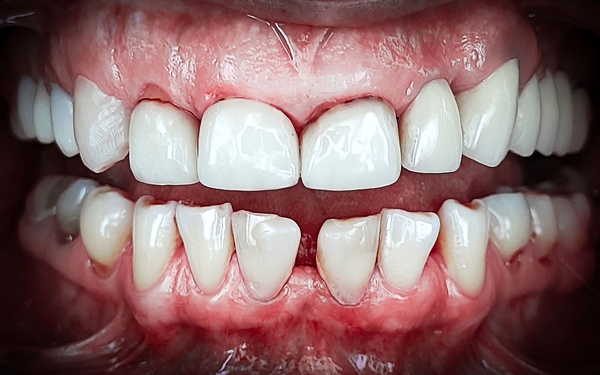 Primo piano di denti leggermente storti con gengive rosse e uno spazio tra i denti superiori e inferiori.