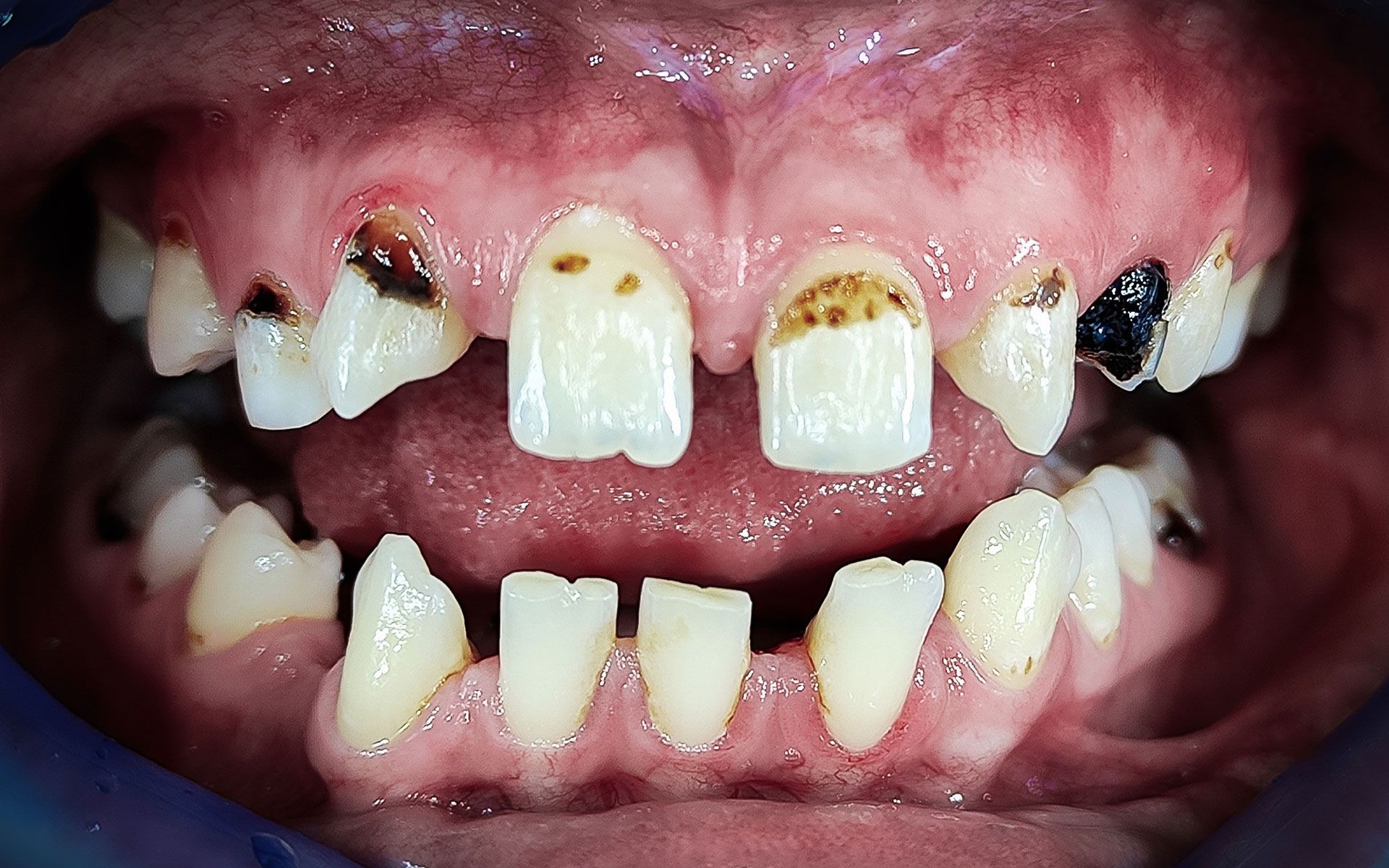 Denti gravemente cariati e scoloriti con numerose carie e denti mancanti in una bocca aperta
