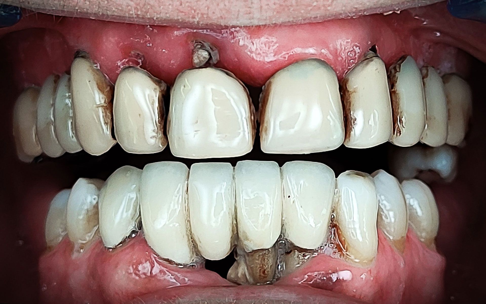Primo piano di denti e gengive con evidenti scolorimenti, spazi vuoti e carie dentali sopra e sotto.