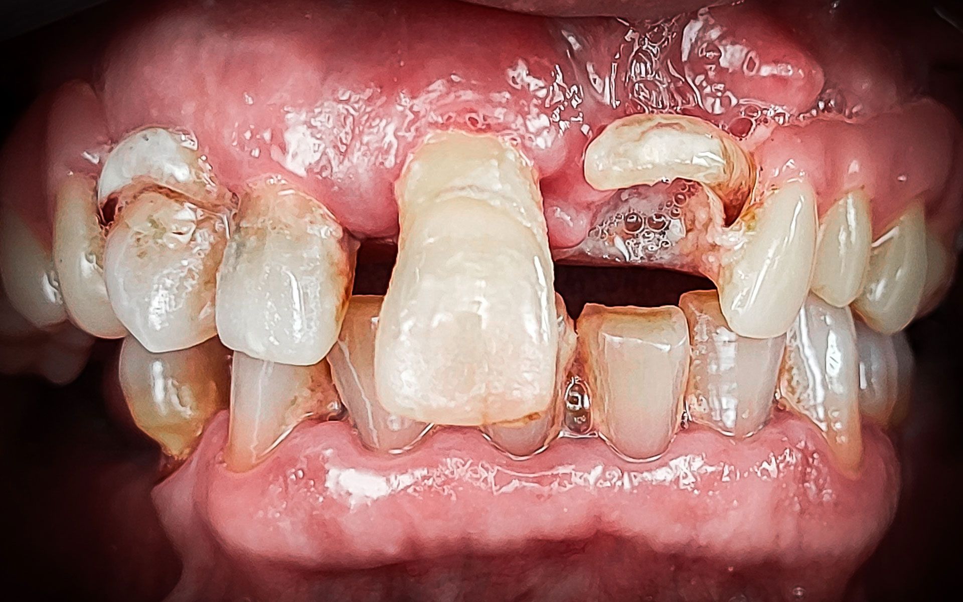 Vista ravvicinata della bocca: denti frontali gravemente cariati e mancanti, con gengive rosse e infiammate.