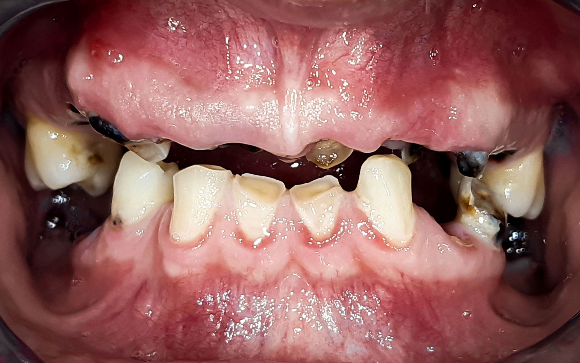 Primo piano di una bocca con denti gravemente cariati e rotti e con denti incisivi superiori mancanti.