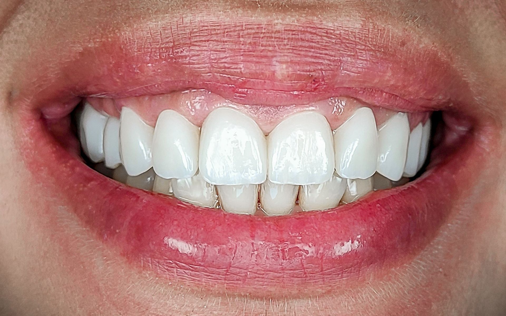 Primo piano di una bocca sorridente che mostra denti bianchissimi e labbra rosa.