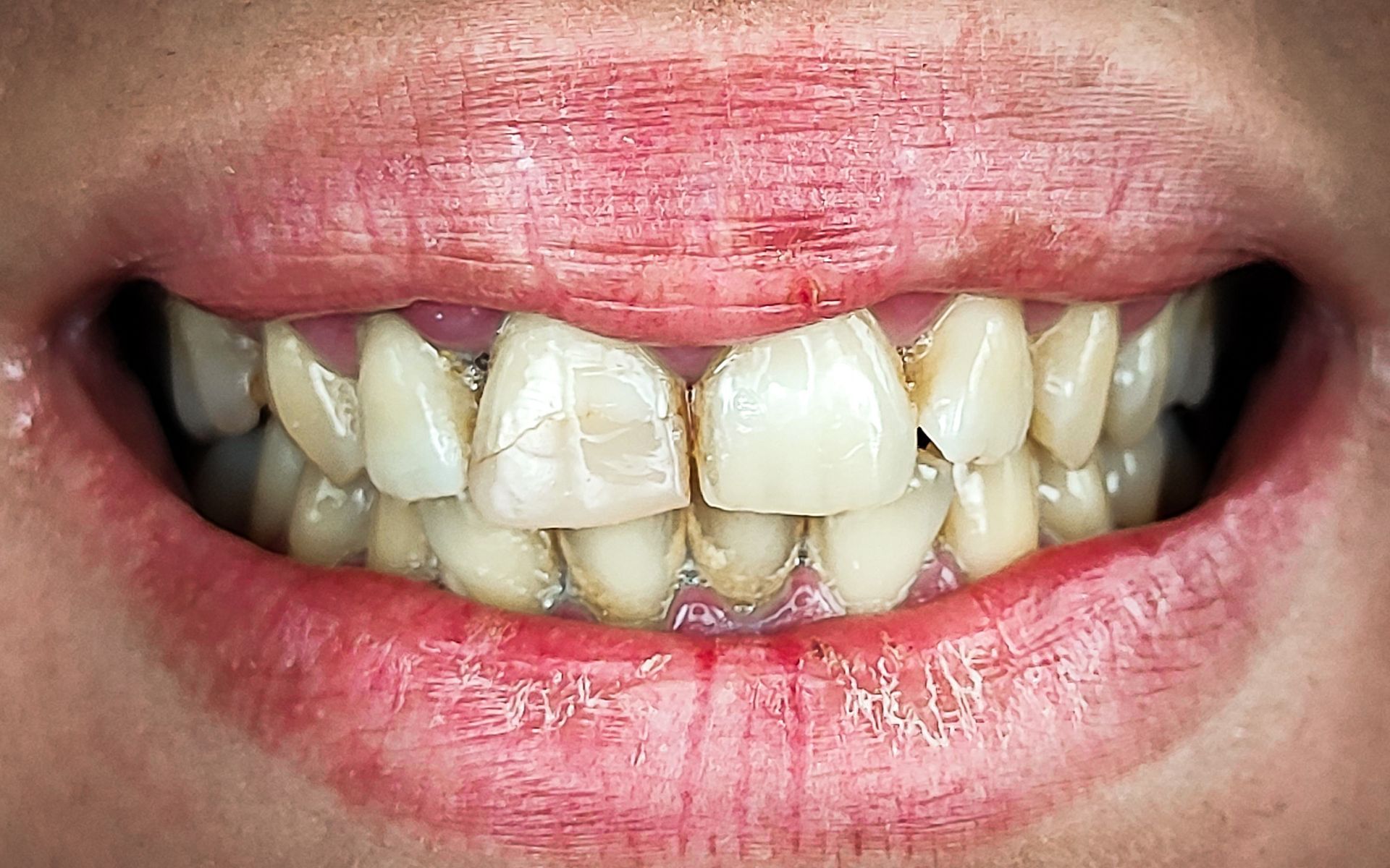 Primo piano di una bocca sorridente con denti affollati e ingialliti e smalto scheggiato.