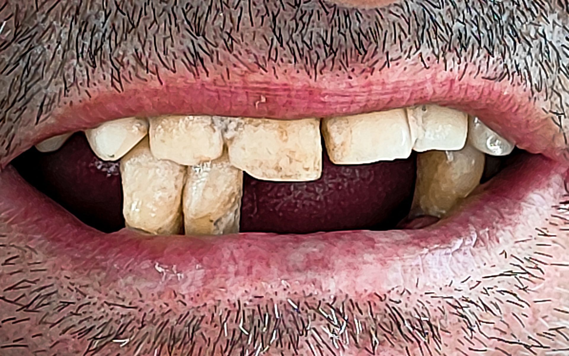 Primo piano di una bocca con denti molto scoloriti e irregolari e labbra screpolate.