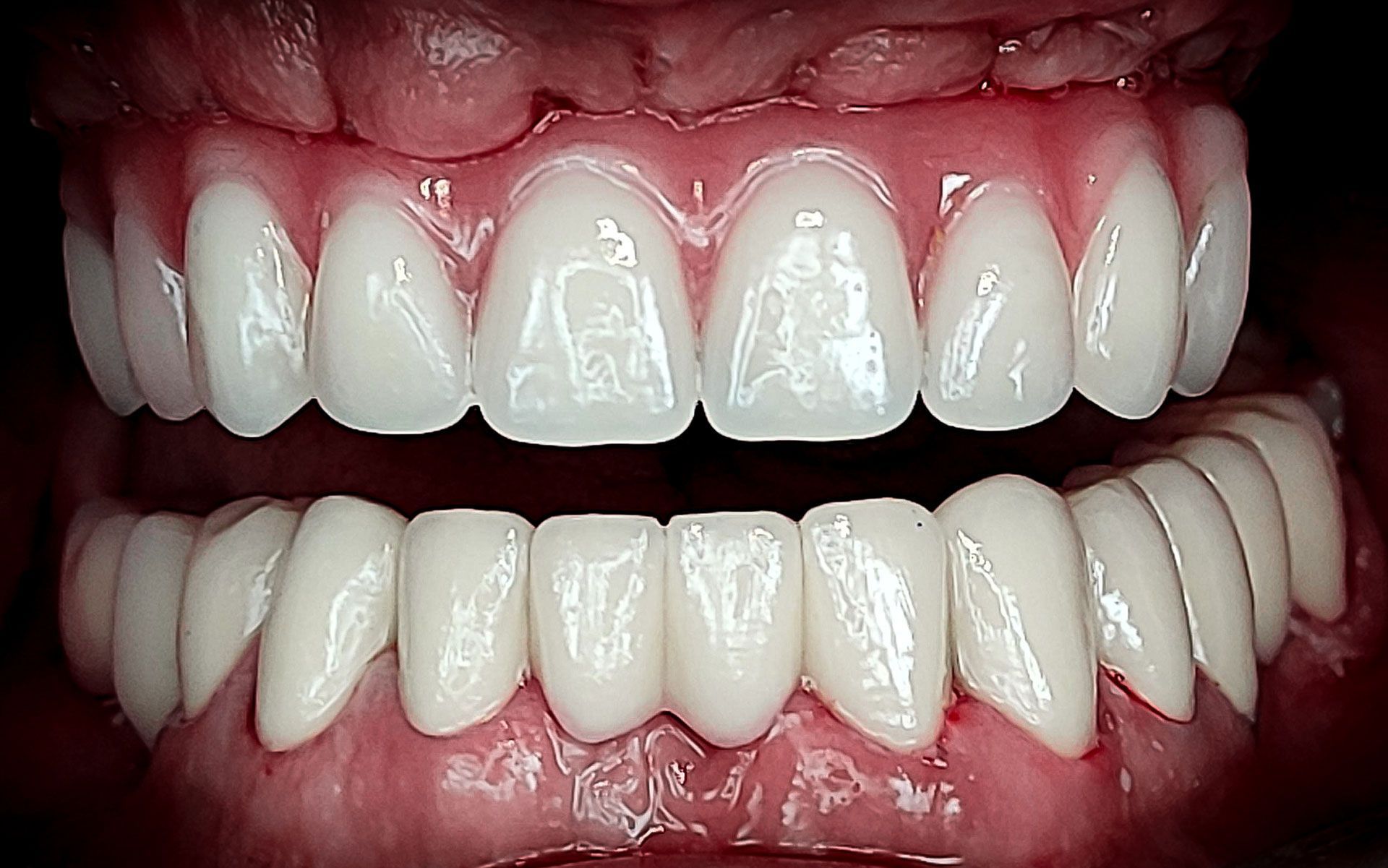 Primo piano della bocca di una persona che mostra denti superiori e inferiori bianchi con gengive rosa, leggermente aperti dai denti.
