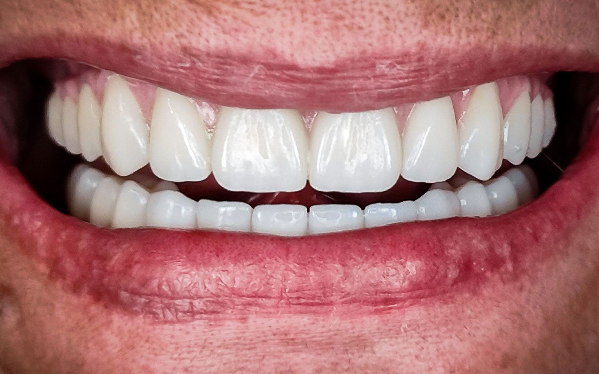 Primo piano di una bocca sorridente che mostra denti bianchi e dritti e labbra rosa.