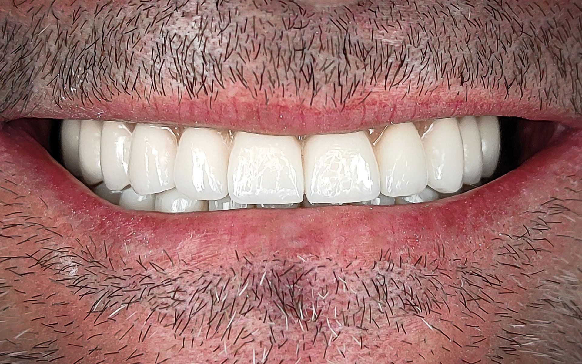 Primo piano di una bocca sorridente con denti bianchi e una leggera peluria sul viso, sulle labbra e sul mento.