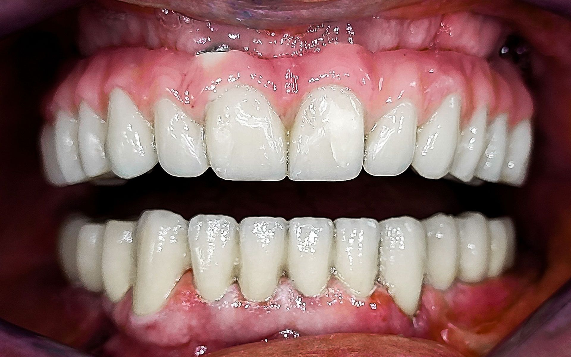 Primo piano di una bocca che mostra i denti superiori e inferiori con gengive rosa.