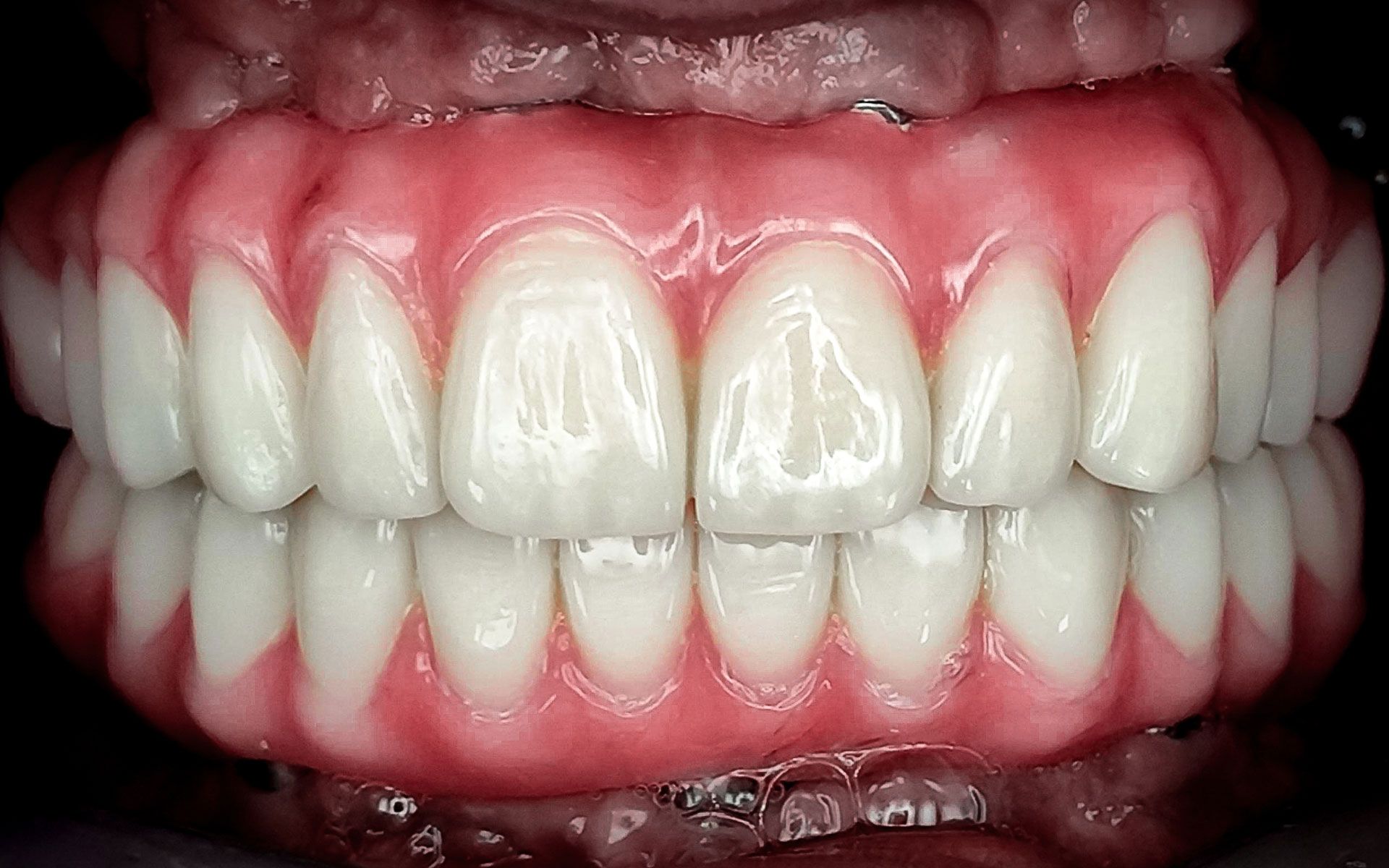 Primo piano di una bocca sorridente con denti bianchi e gengive rosa in vista.