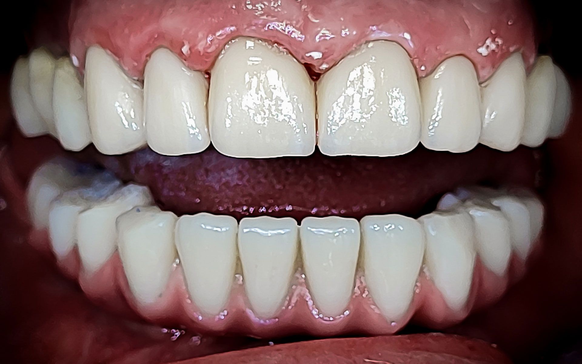 Primo piano di una bocca aperta che mostra i denti superiori e inferiori con uno spazio centrale tra gli incisivi superiori.