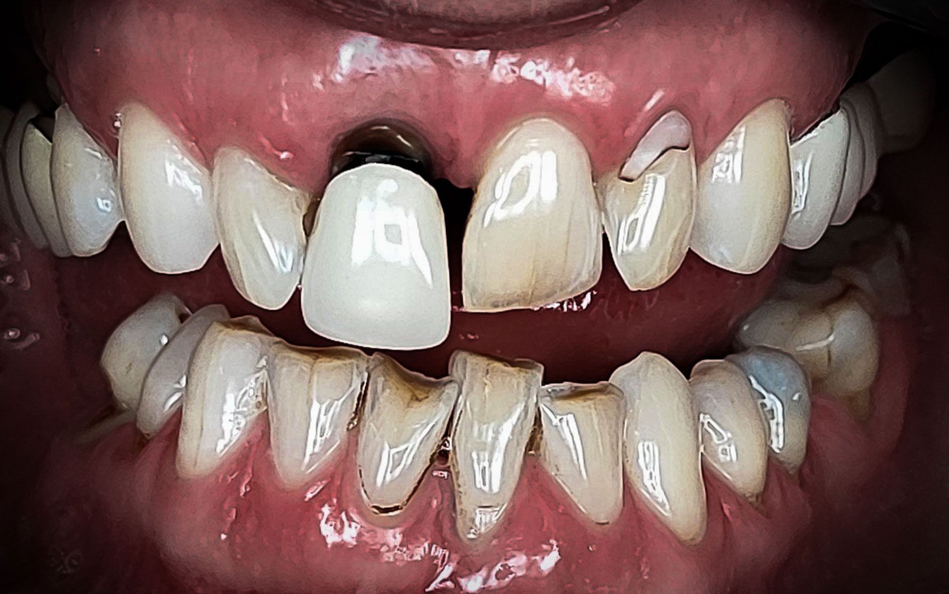 Primo piano di denti gravemente cariati, disallineati, scoloriti e con spazi vuoti.