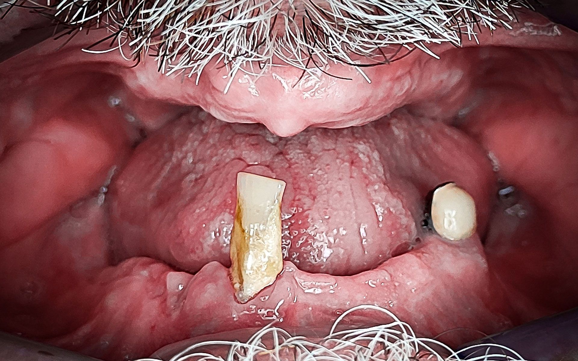 Primo piano di una bocca che mostra le gengive con denti mancanti e un frammento di dente ingiallito.