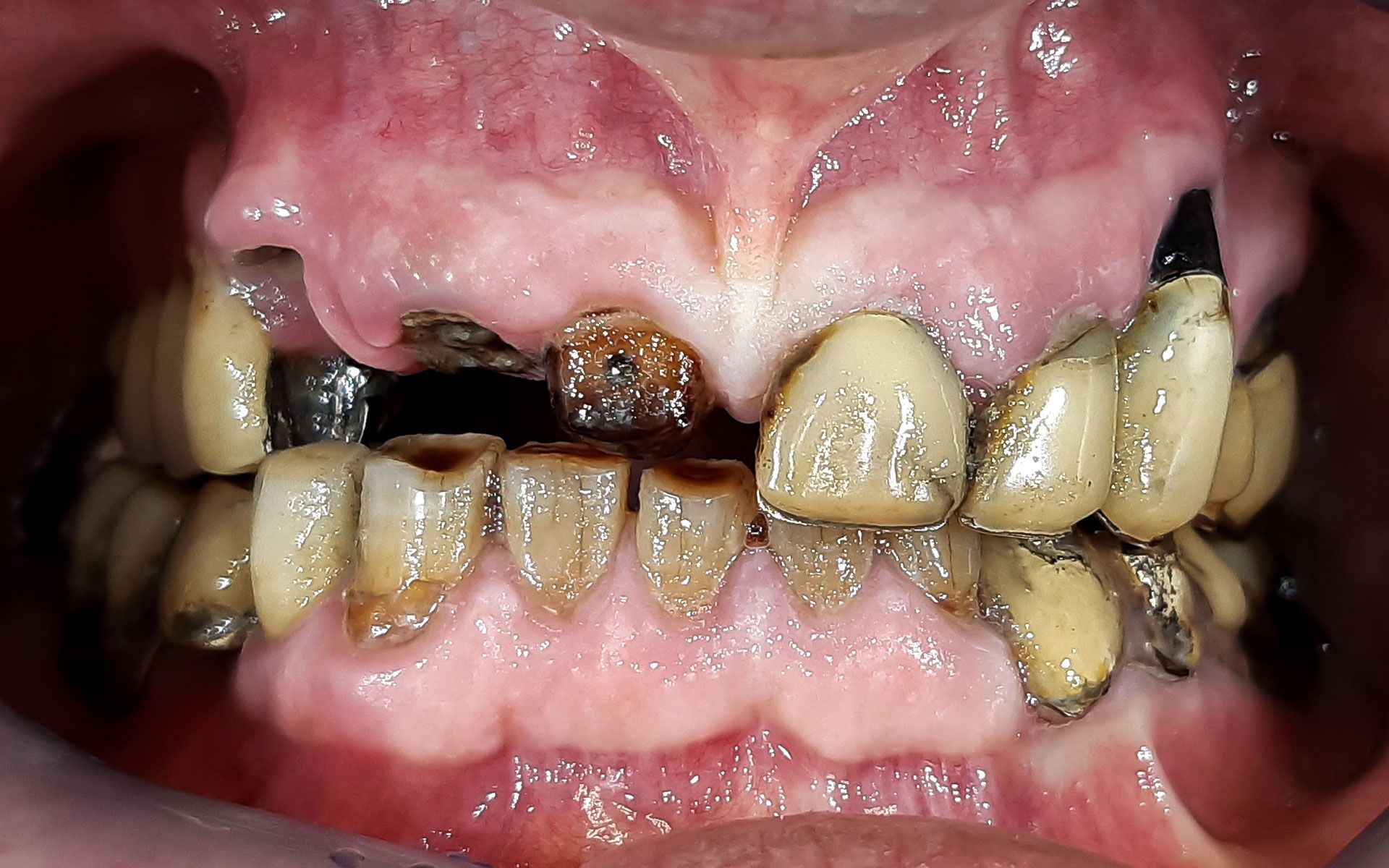 Primo piano di denti gravemente cariati con forti scolorimenti marroni e neri e smalto mancante.