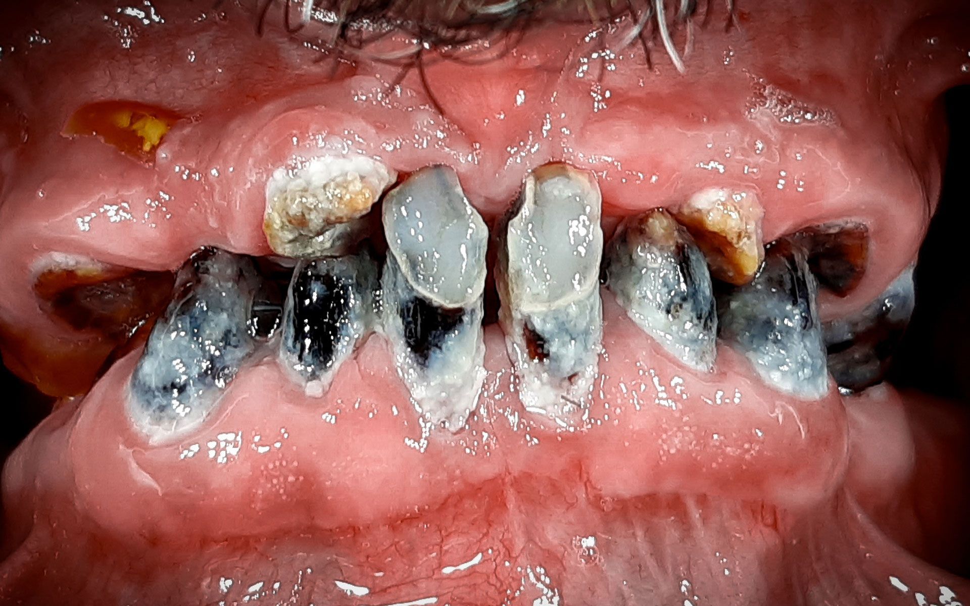 Primo piano di denti gravemente cariati con scolorimento nero, giallo e bianco e tessuto gengivale visibile.