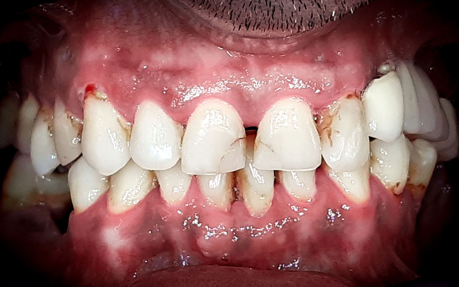 Primo piano di denti con grave affollamento e infiammazione gengivale.