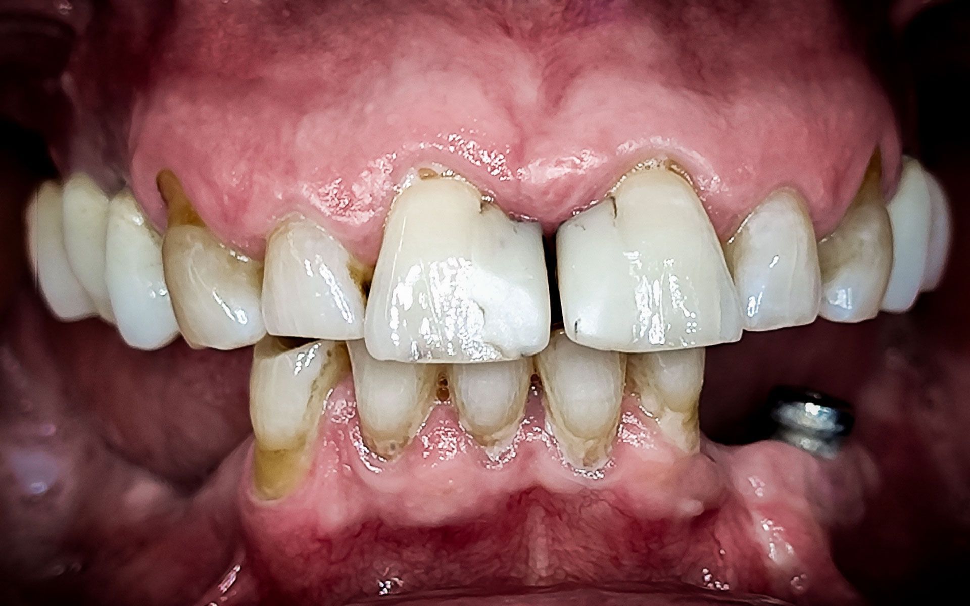 Primo piano di denti e gengive con incisivi superiori prominenti e malocclusione dentale nell'arcata inferiore.