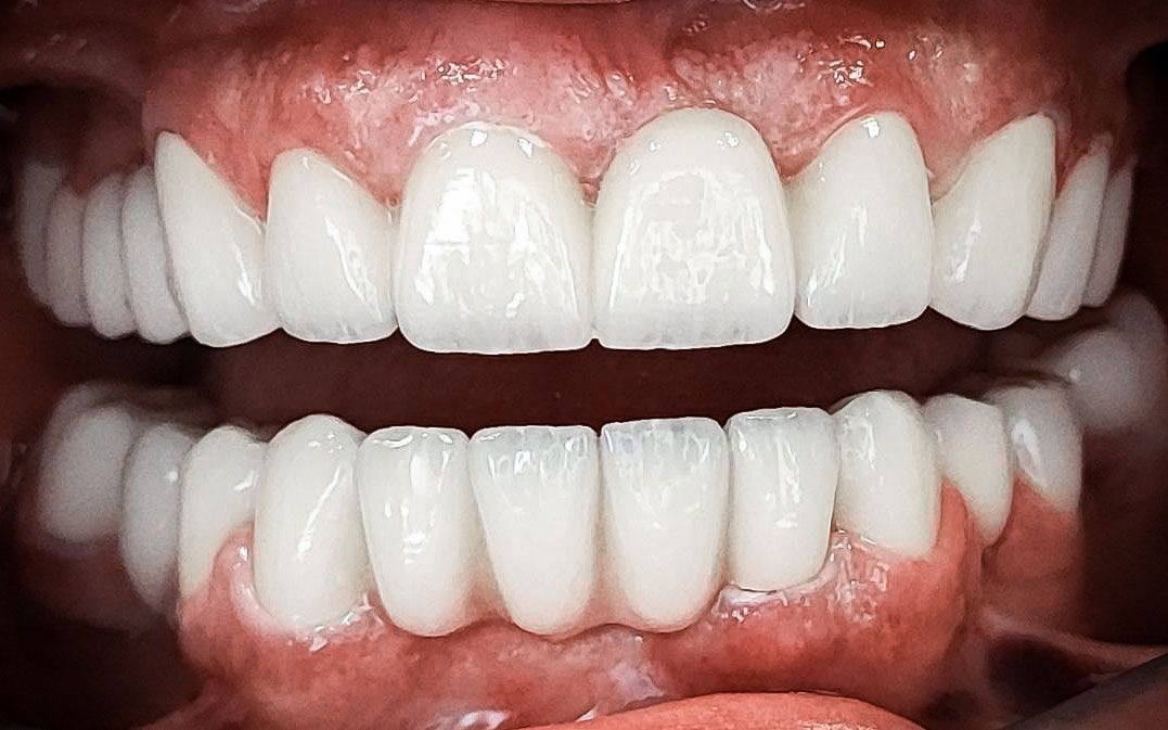 Primo piano di una bocca che mostra denti superiori e inferiori di un bianco brillante con gengive visibili.