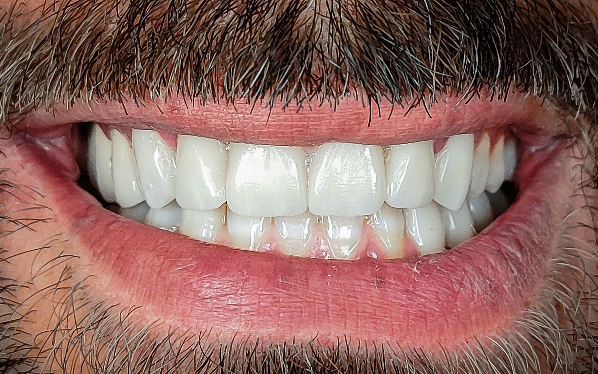 Primo piano di una bocca sorridente con denti bianchi e labbra rosa, che lascia intravedere dei baffi scuri nella parte superiore.