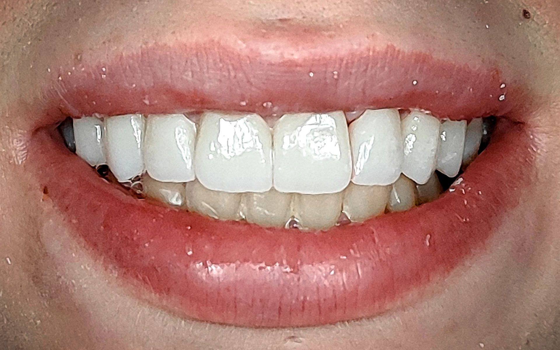 Primo piano di una bocca sorridente con denti bianchi e labbra rosa