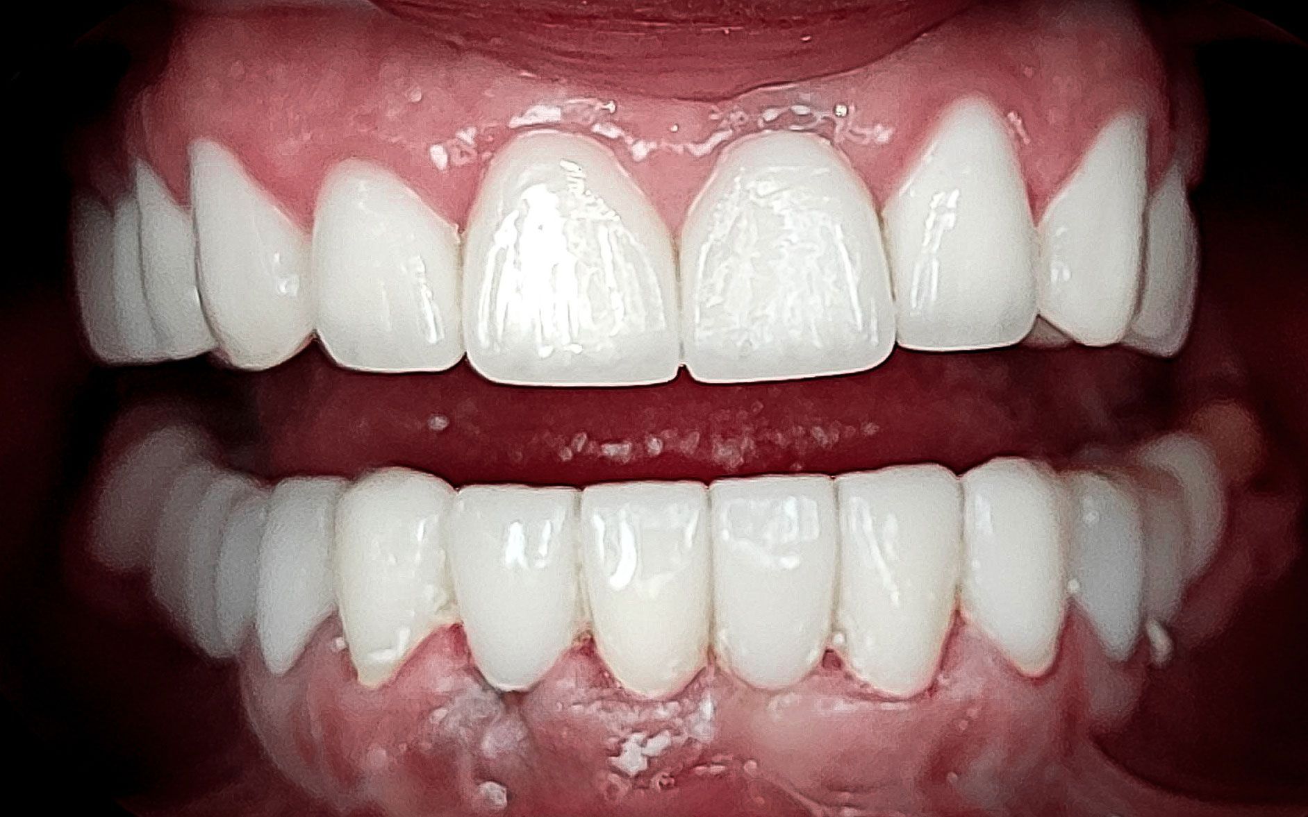 Primo piano di una bocca sorridente che mostra denti bianchissimi e gengive rosa.