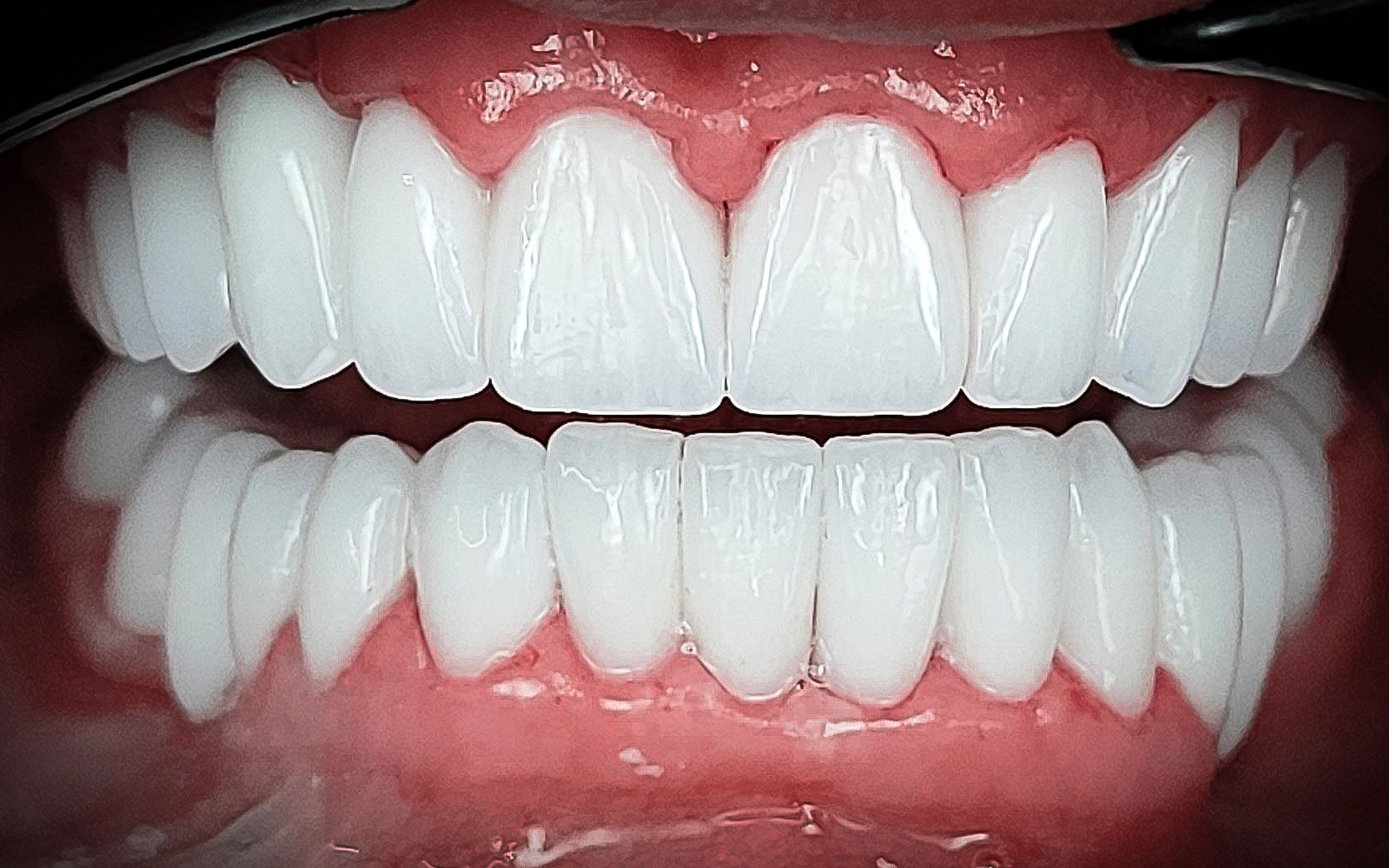 Primo piano di denti bianchissimi e gengive rosa in una bocca aperta.