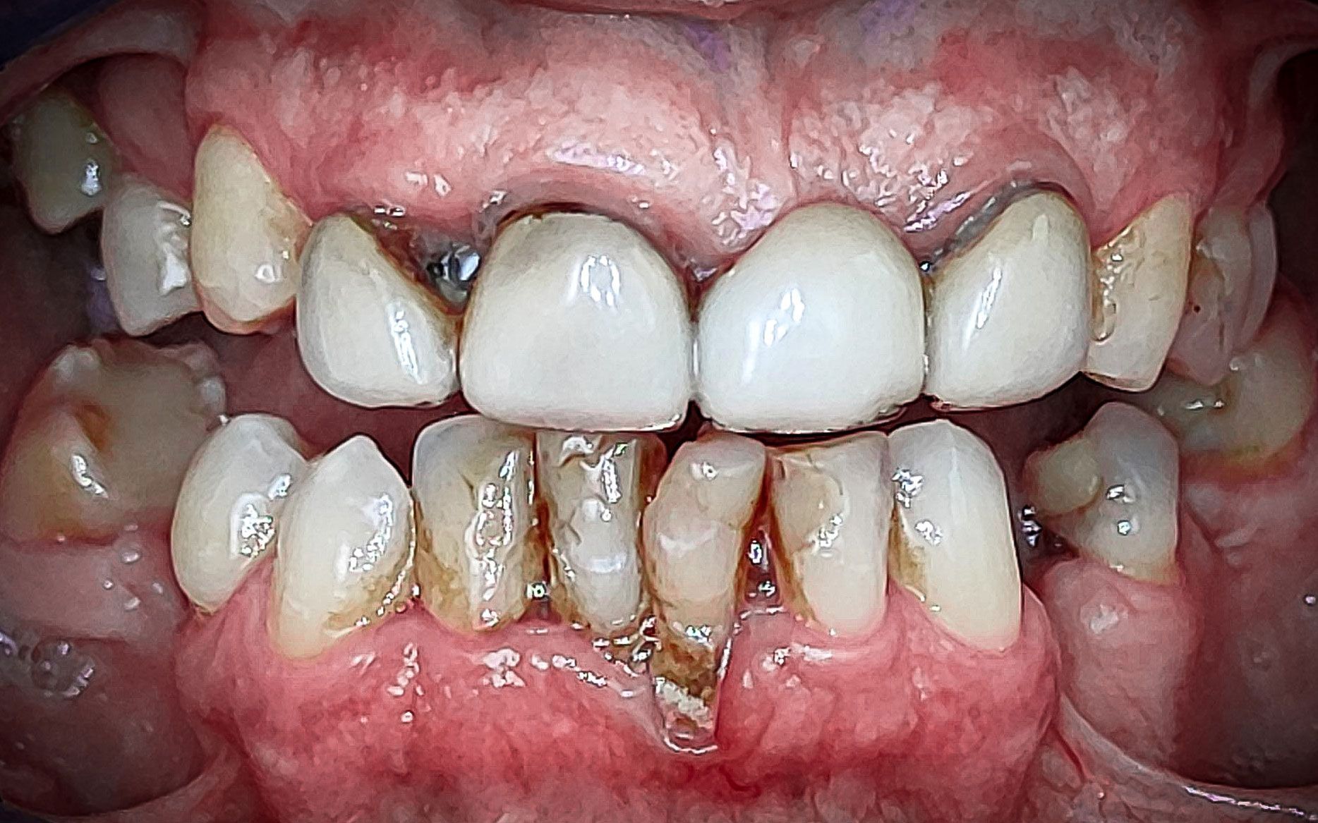 Primo piano di denti umani gravemente affollati e cariati, con macchie giallo-brunastre e irritazione gengivale.