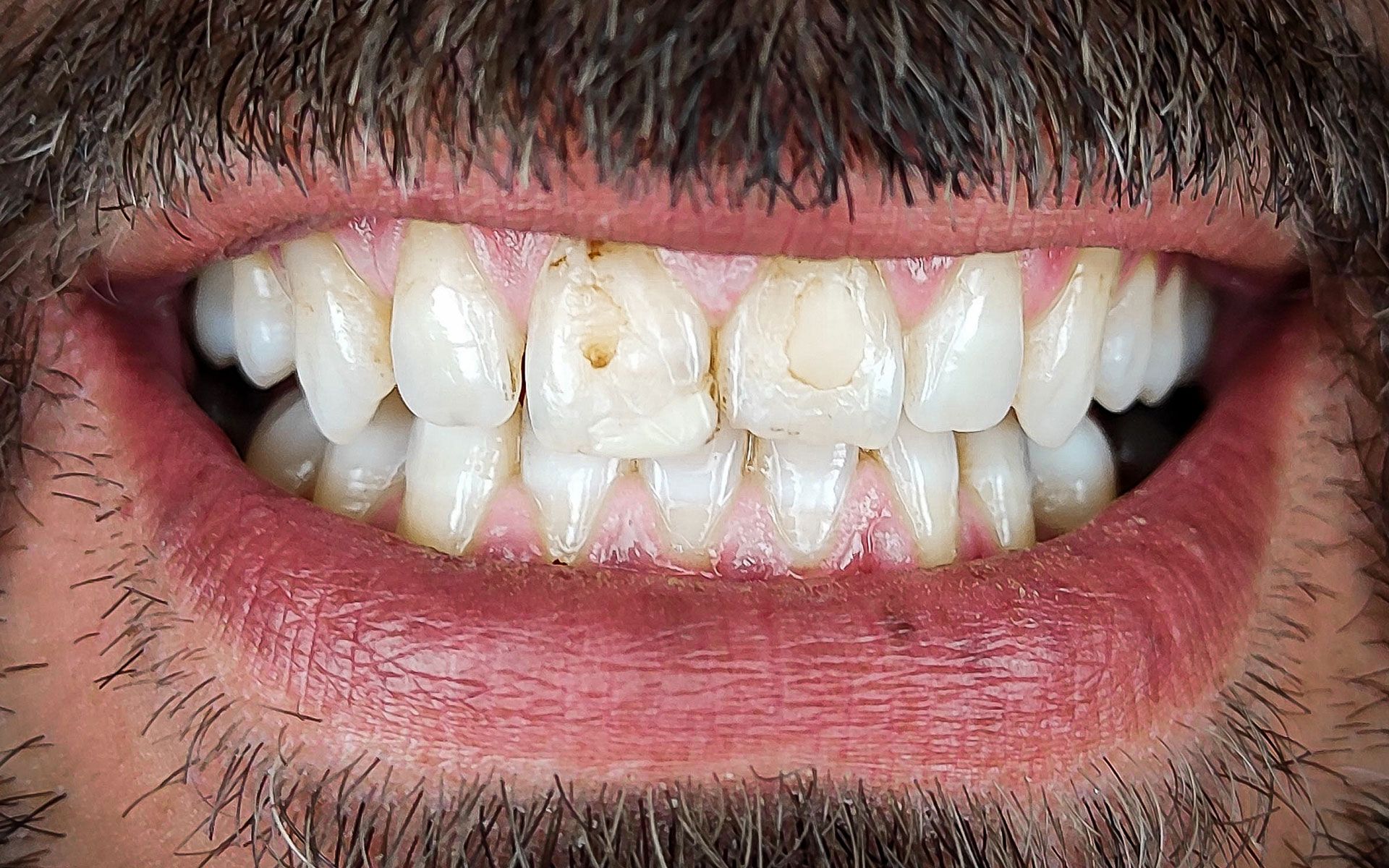 Primo piano di una bocca sorridente che mostra denti bianchi con un leggero ingiallimento e spazi tra di loro.