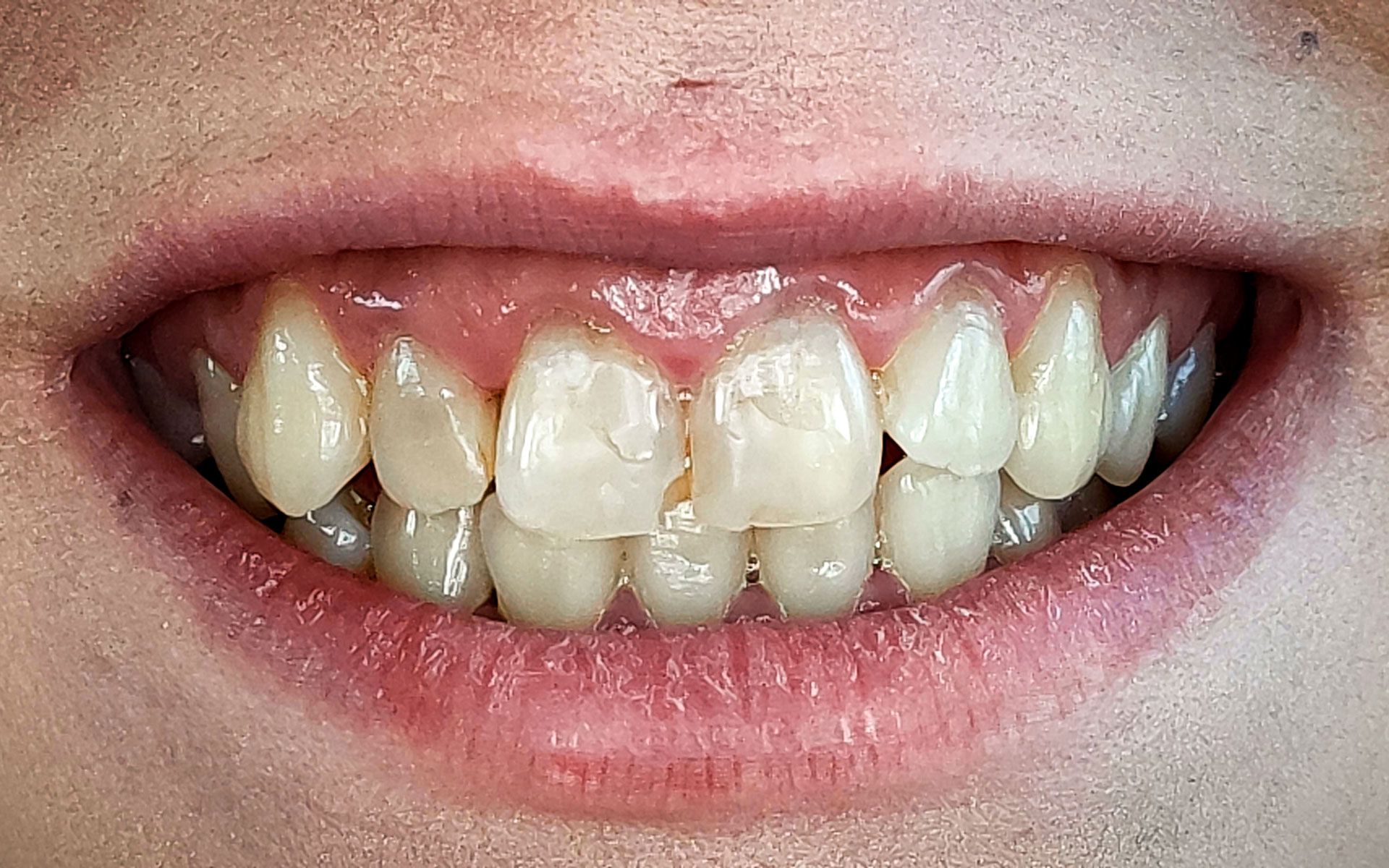 Primo piano di una bocca sorridente con denti macchiati e uno spazio vuoto dovuto alla mancanza di un incisivo.