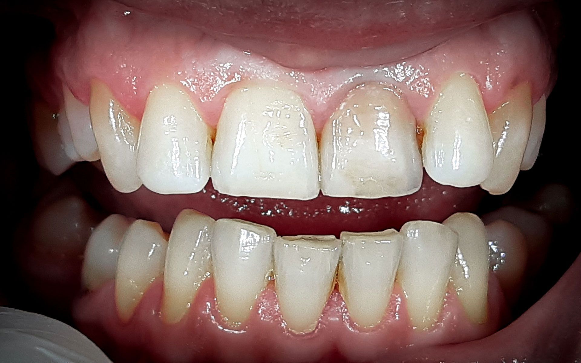 Primo piano di denti e gengive, che mostra gli incisivi superiori e inferiori in un ampio sorriso.