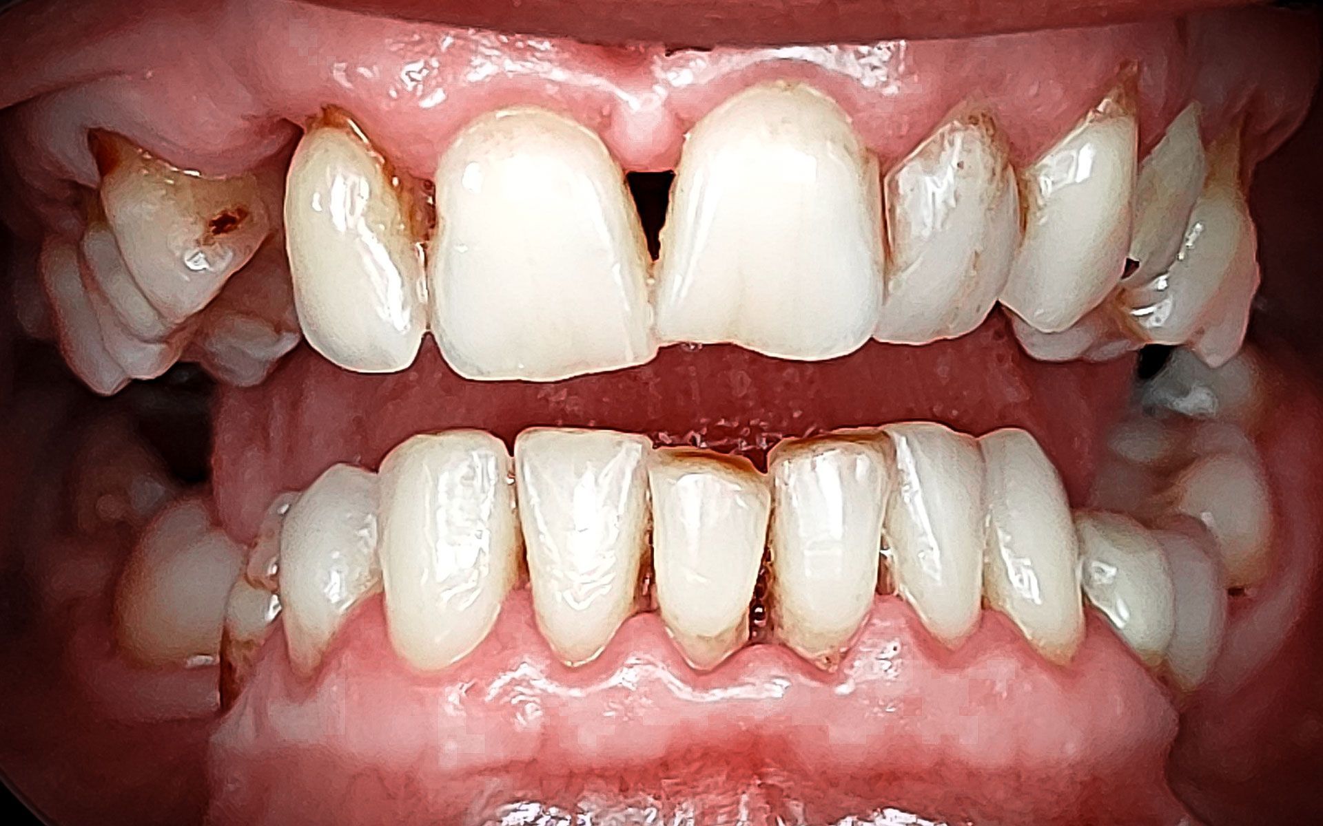Primo piano di denti affollati e disallineati con gengive visibili a bocca aperta.