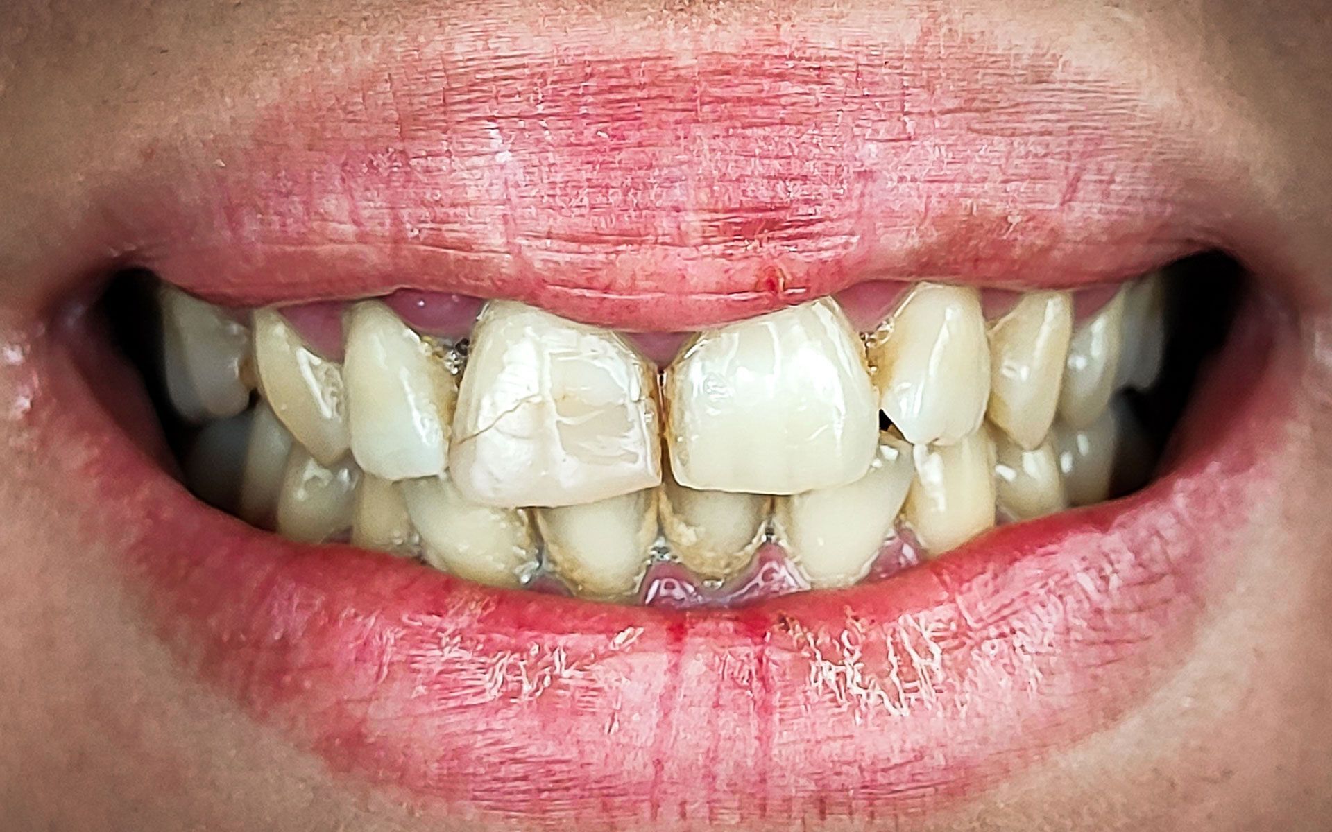 Primo piano di una bocca con denti scoloriti e storti e uno spazio visibile tra gli incisivi.