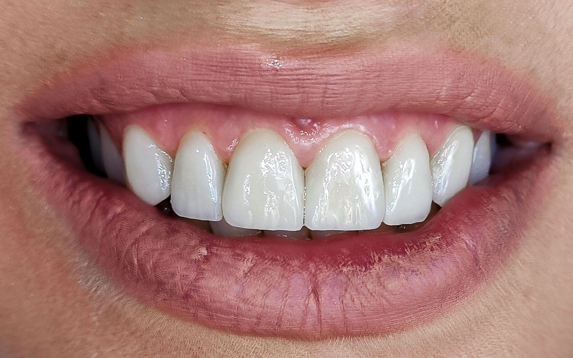 Primo piano di una bocca sorridente con denti bianchi e labbra rosa