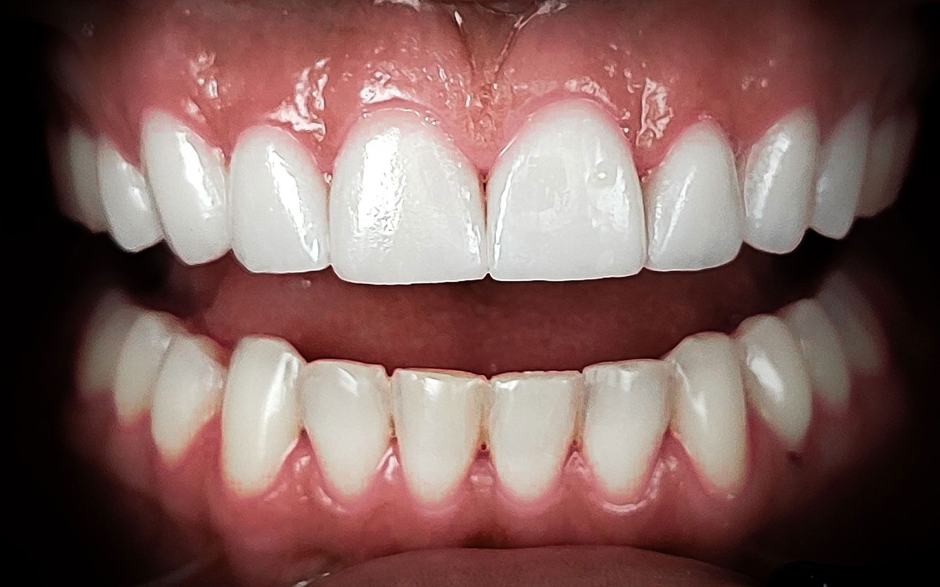 Primo piano di una bocca sorridente che mostra denti superiori e inferiori bianchi e gengive rosa.