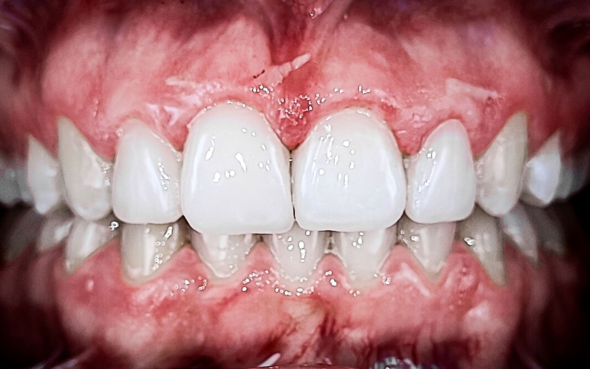 Primo piano di denti frontali storti e gengive rosse e infiammate, che mostrano un disallineamento dentale.
