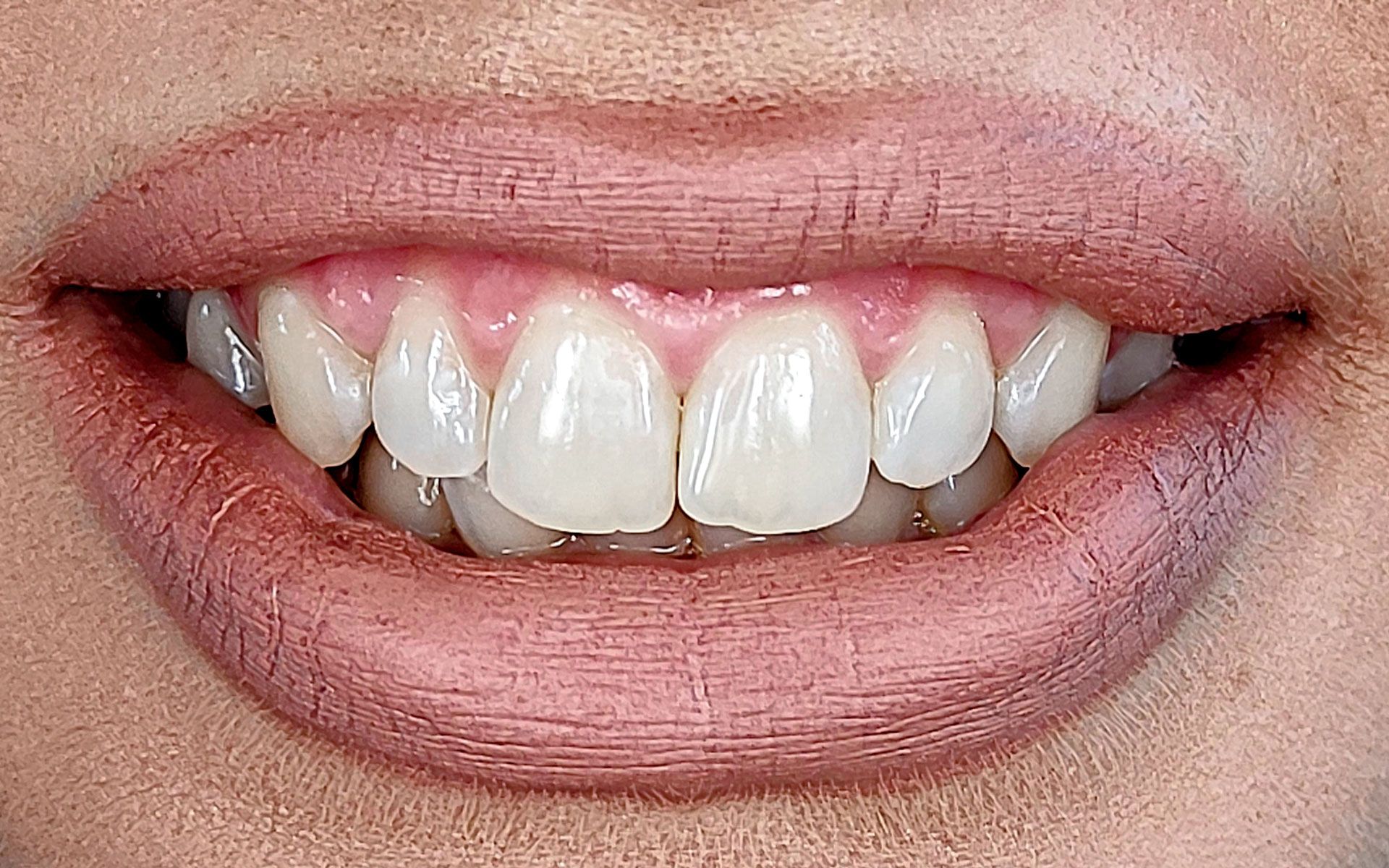 Primo piano di una bocca sorridente con denti bianchi e labbra rosa
