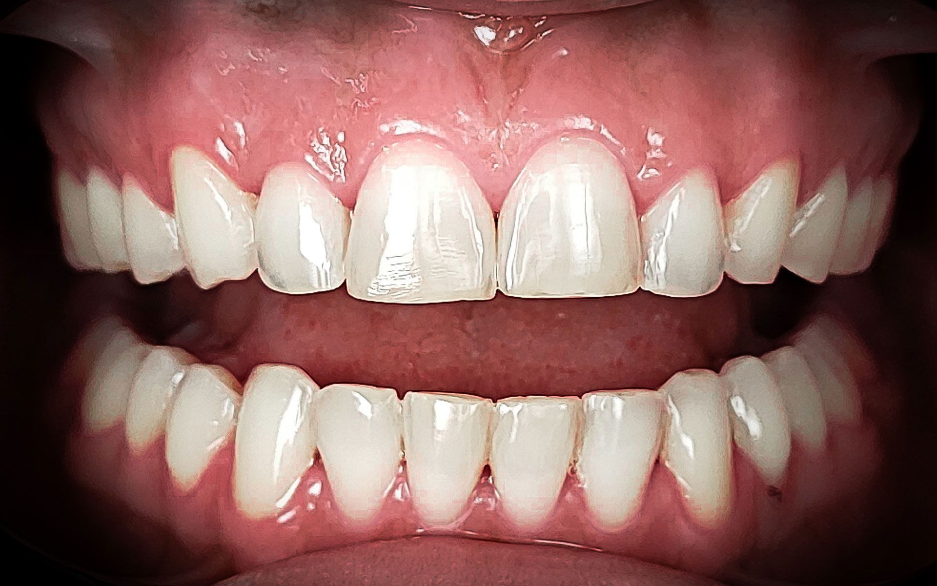 Primo piano di una bocca sorridente con denti bianchi e gengive rosa