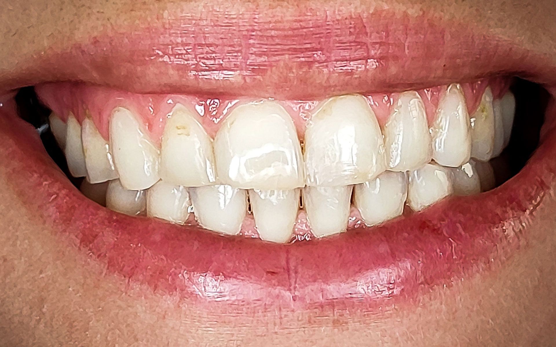 Primo piano di una bocca sorridente che mostra denti bianchi e dritti e labbra rosa.
