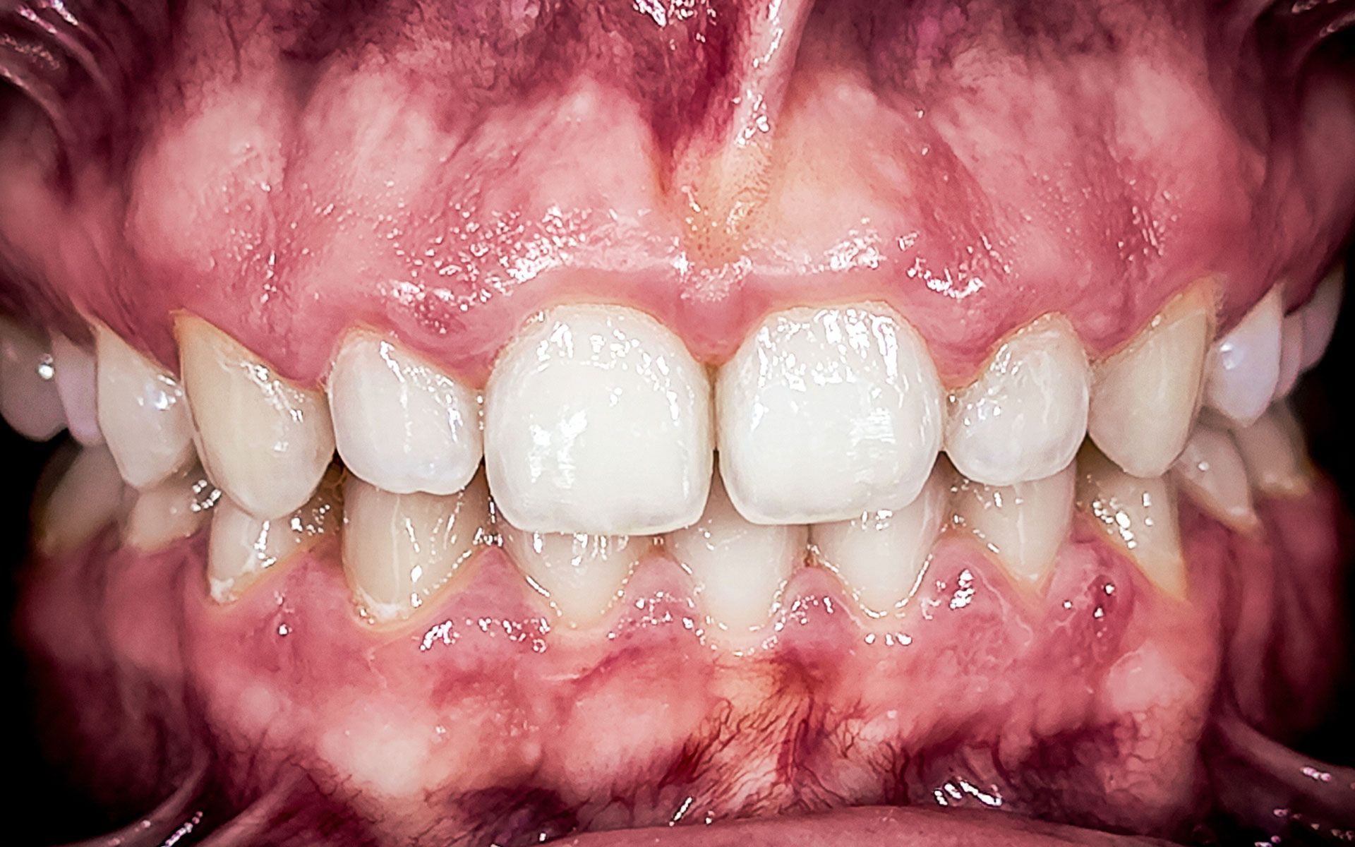 Primo piano della bocca di una persona con i denti serrati, che mostra gengive e labbra.