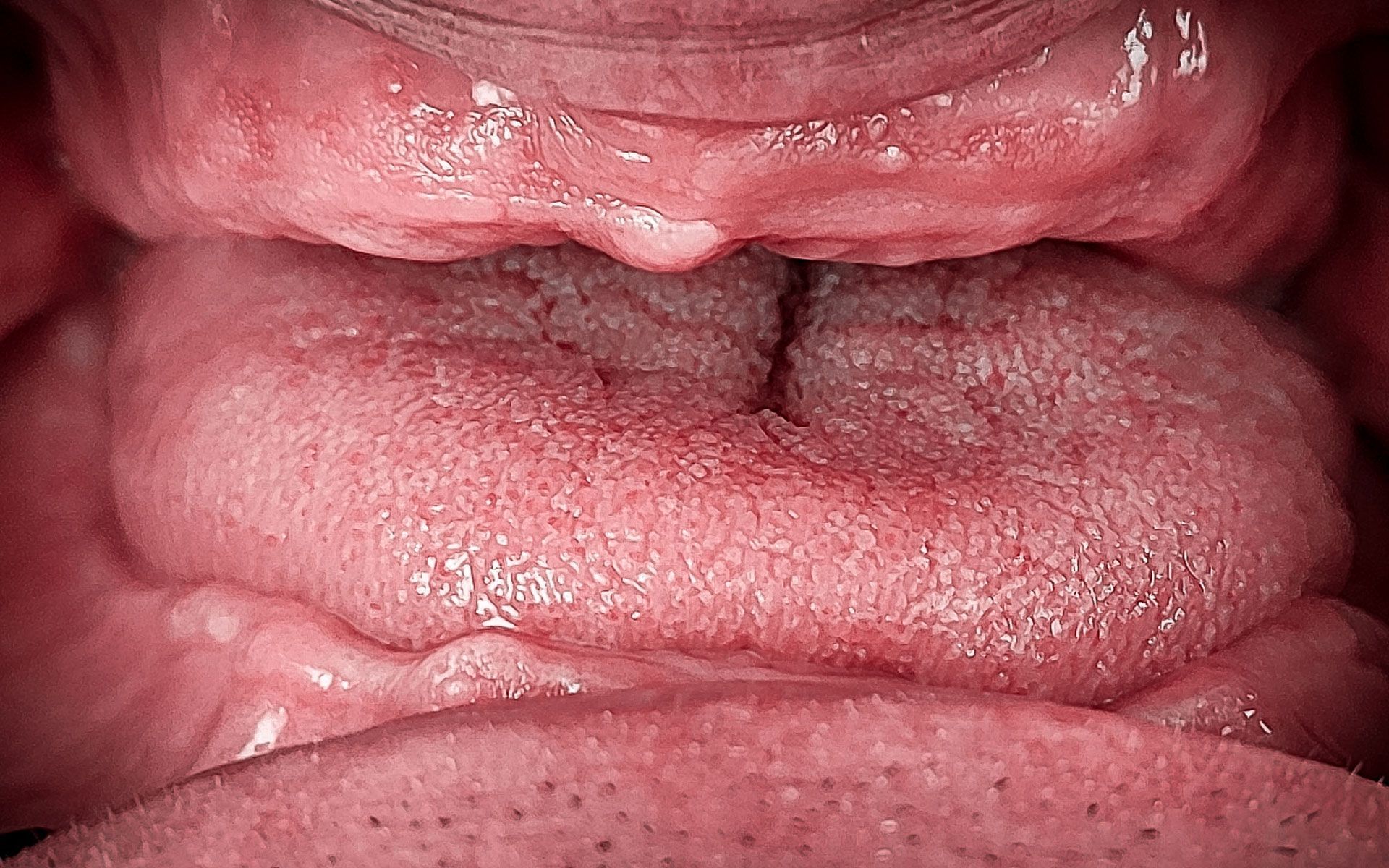 Primo piano di una lingua con macchie bianche e interno della bocca rosa