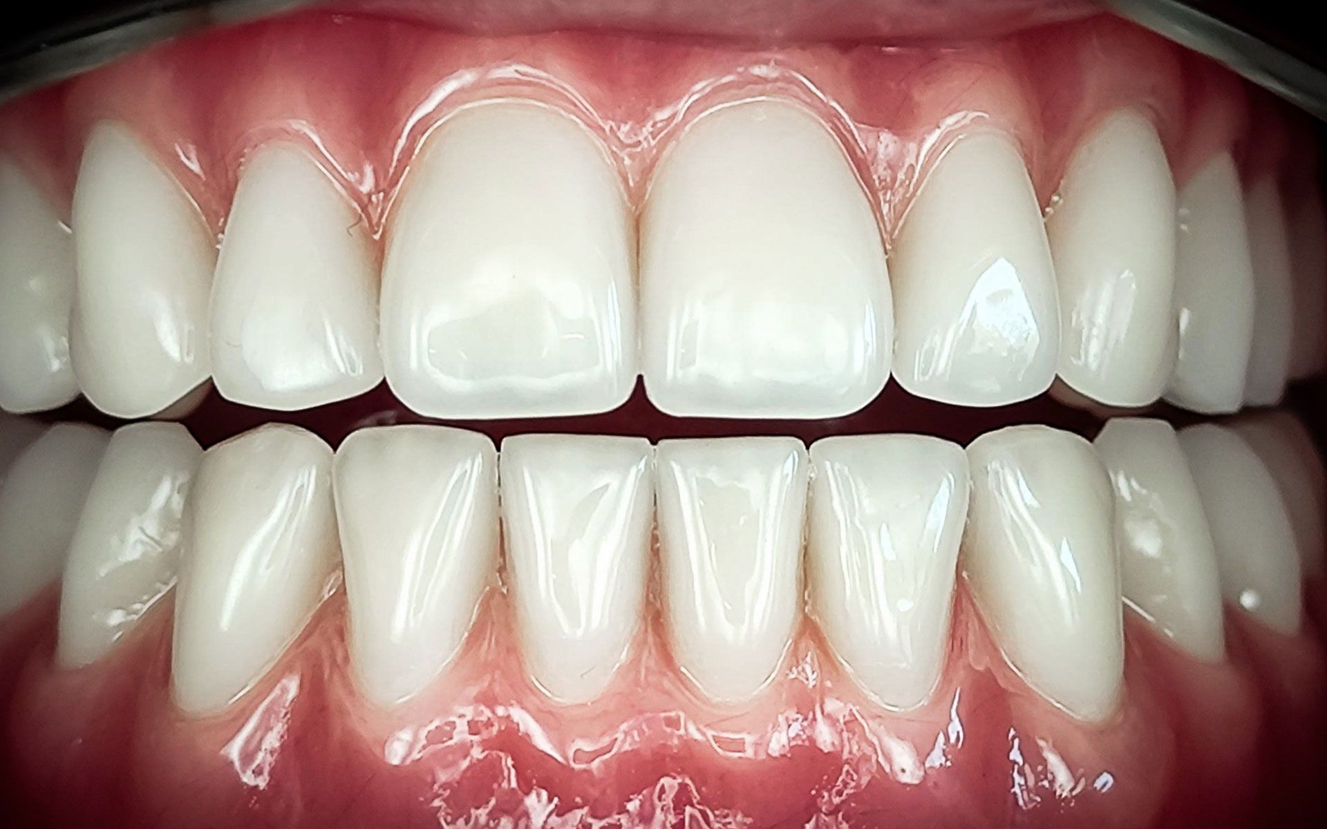 Primo piano di una bocca sorridente con denti bianchi e gengive rosa, denti superiori e inferiori visibili.