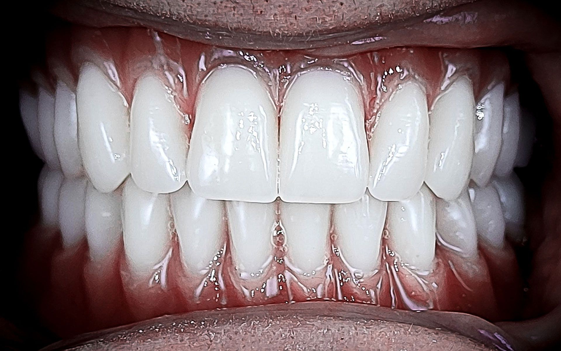 Primo piano di una bocca sorridente che mostra denti bianchi e gengive rosse.