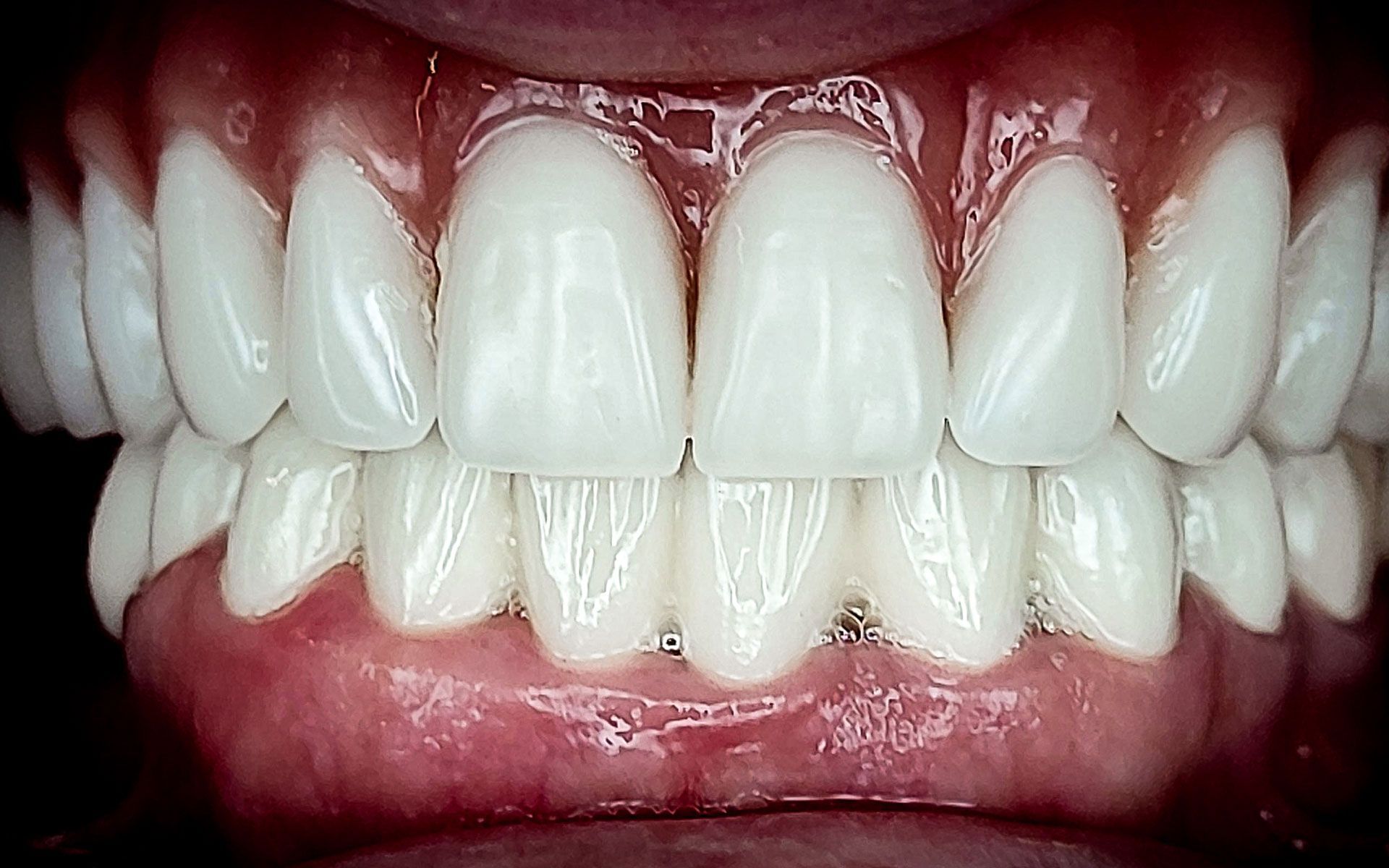 Primo piano di una bocca con denti e gengive bianchissimi ben visibili mentre sorride.