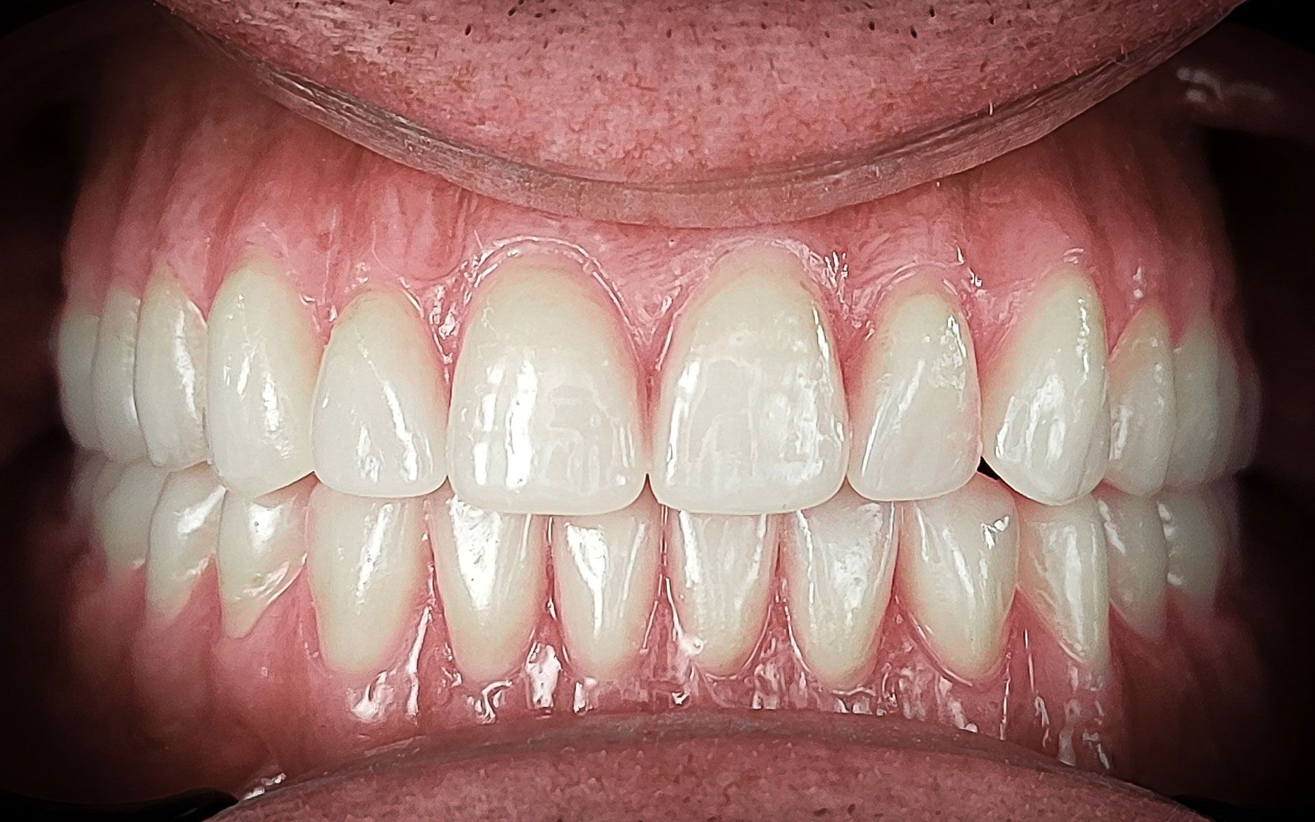 Primo piano di una bocca sorridente che mostra denti bianchi allineati e gengive rosa.
